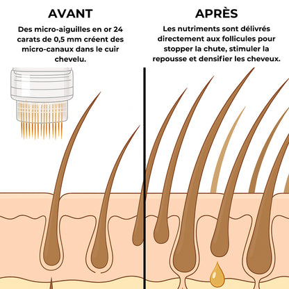 Technologie Capillaire  Micro-infuse® Homme